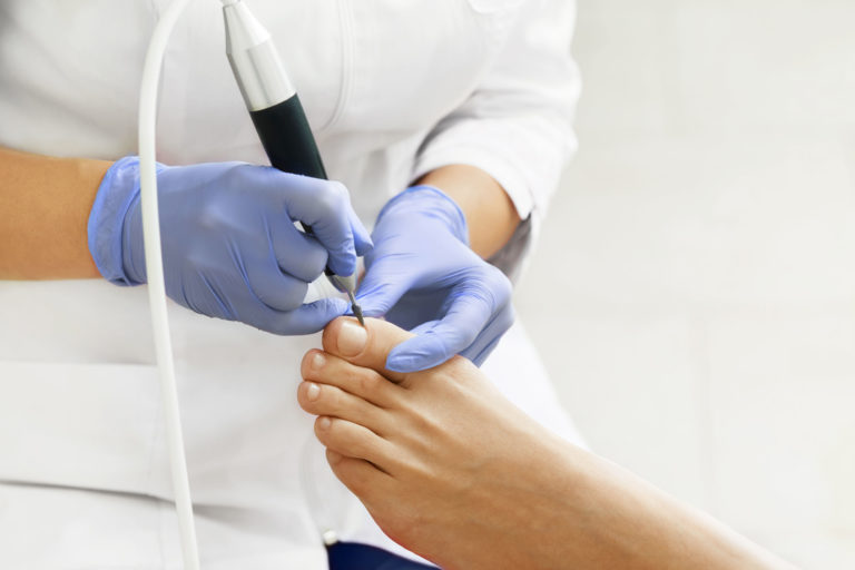 Soin de pédicurie médicale : meulage d'un ongle épaissi par un pédicure-podologue ganté