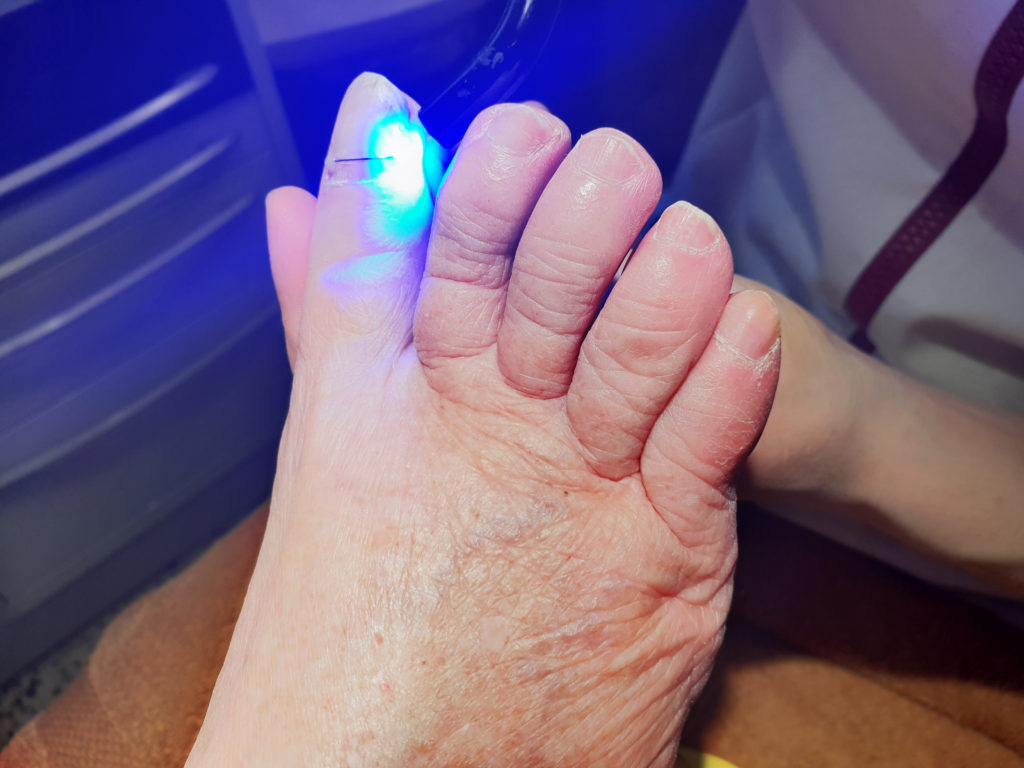 Photopolymérisation du plot de résine qui fixe le fil de titane sur l'ongle, au Cabinet Olagnier à Bron