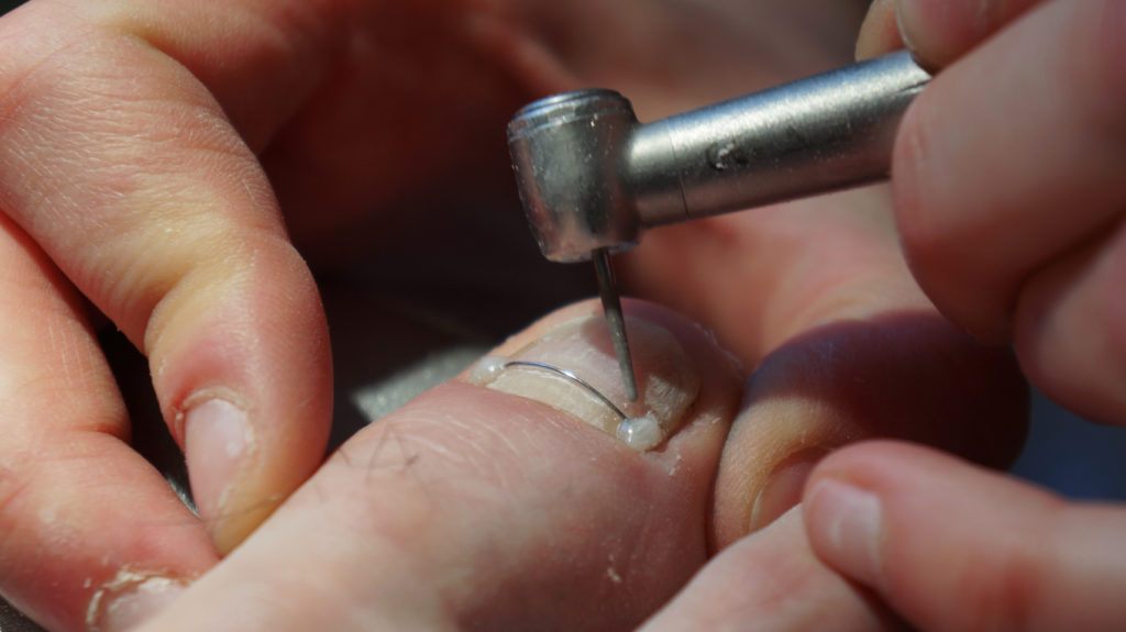 Orthonyxie au titane en place sur l'ongle du gros orteil, au Cabinet Olagnier à Bron