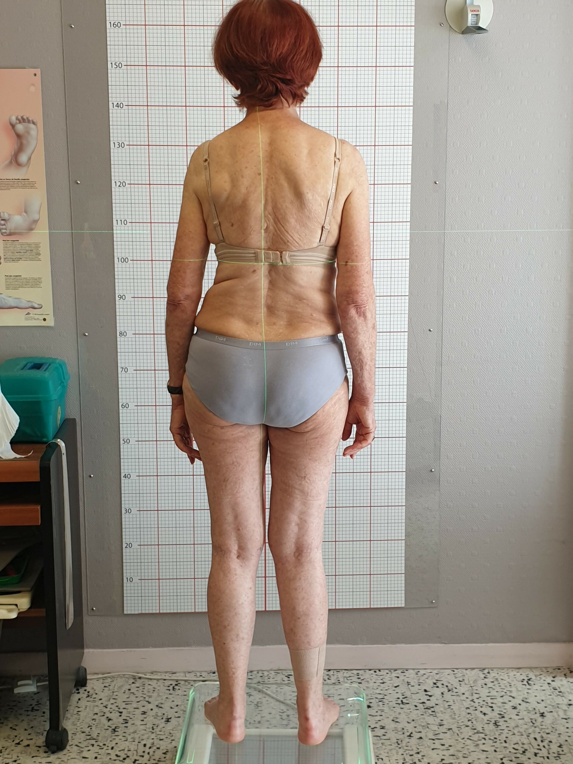 Évaluation de la verticalité au laser chez un patient, mettant en évidence un défaut d'alignement postural