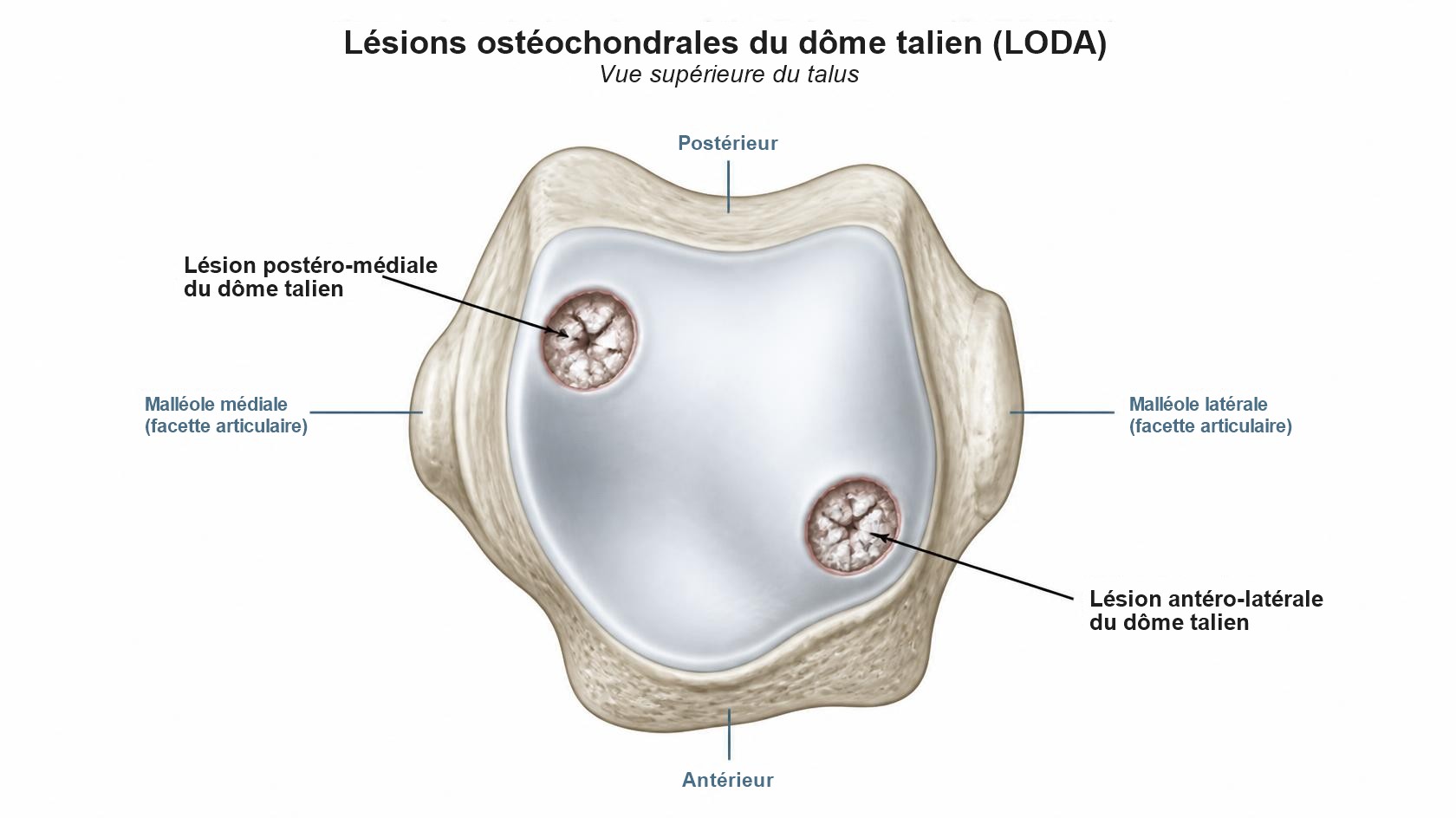 Lésions ostéochondrales du dôme talien (LODA), vue supérieure du talus : lésion postéro-médiale et lésion antéro-latérale du dôme talien, situées entre les facettes des malléoles médiale et latérale.
